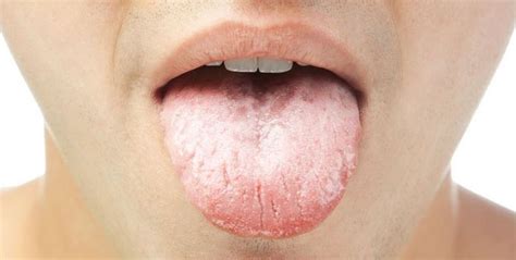 cancer de lengua